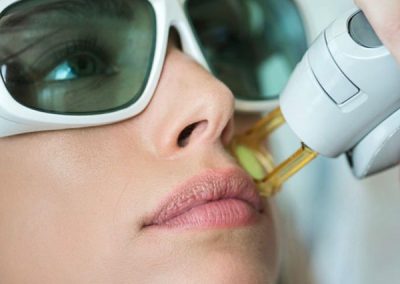 All white Laser Service