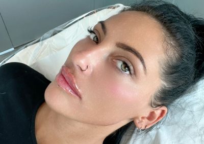 Jawline Filler