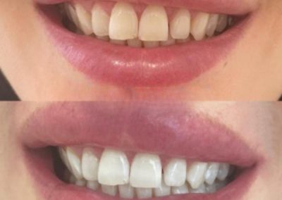 Teeth Whitening