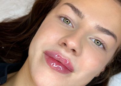 Lip Fillers